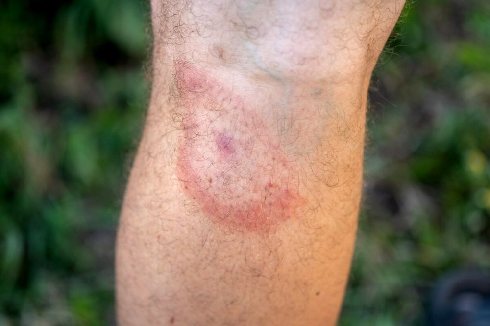 Lyme Disease Prevention and Treatment